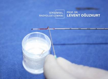 İğne biyopsisi ile doku örneği alınması
