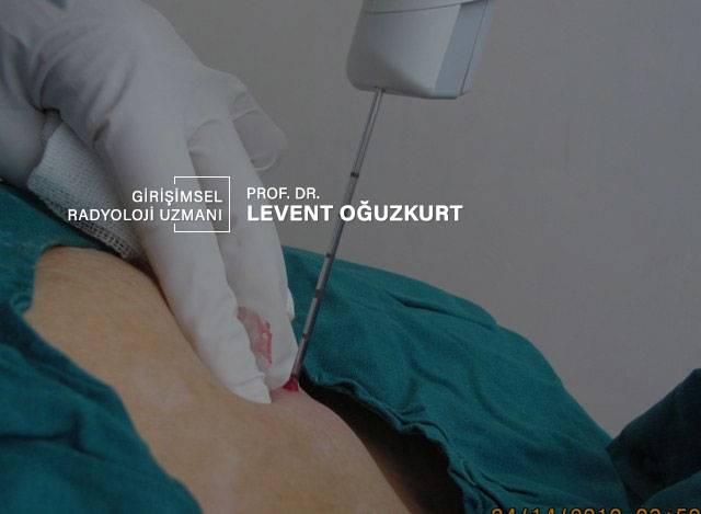 Görüntüleme eşliğinde yapılan iğne biyopsisi
