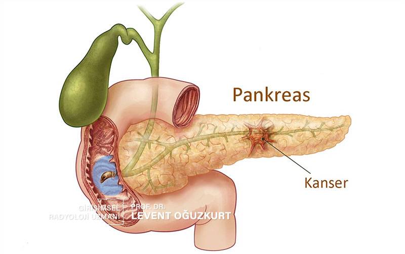 Tomografi eşliğinde pankreas iğne biyopsisi